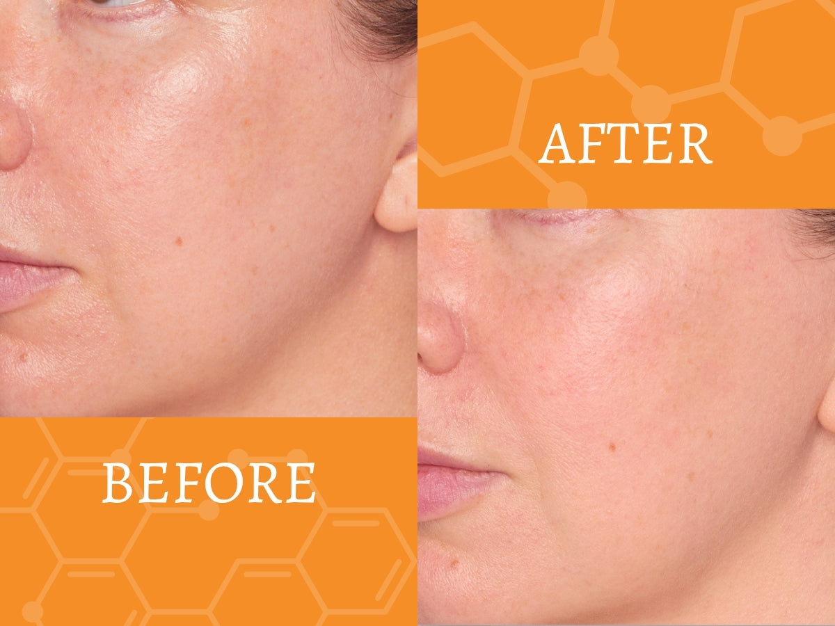 Before and after comparison of a person's face with an orange background - New Level Skincare