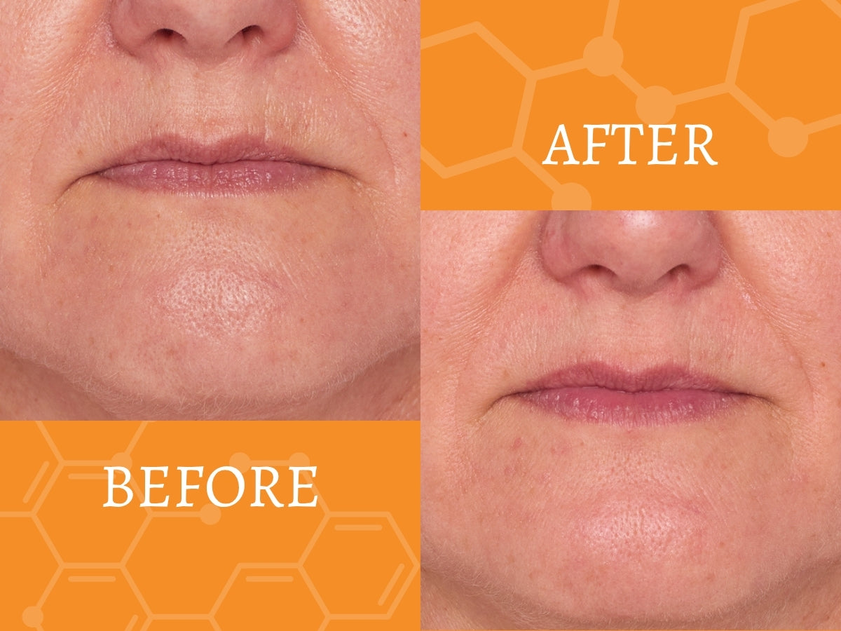 Before and after comparison of a person's lips and chin with an orange background. New Level Skincare