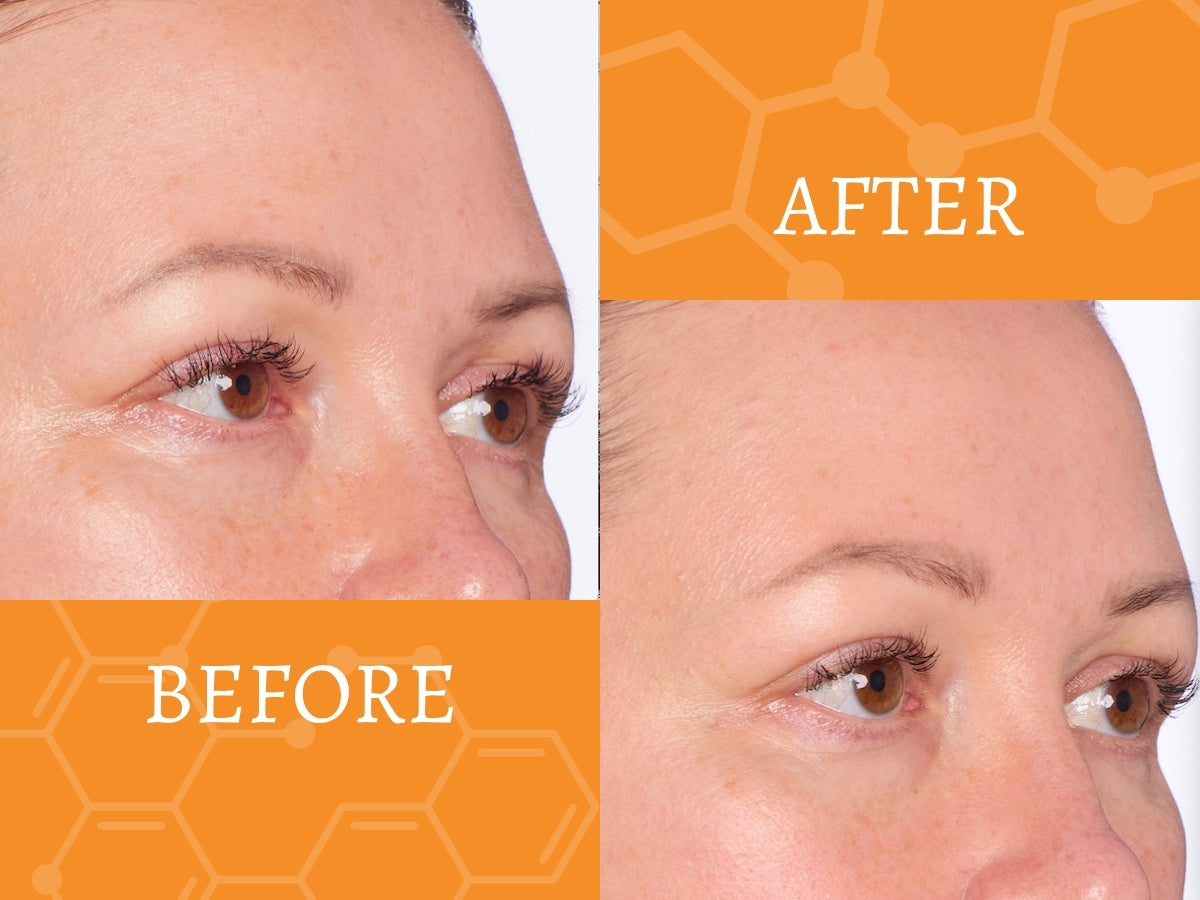 Before and after comparison of a woman's eye area with an orange background and 'AFTER' text.