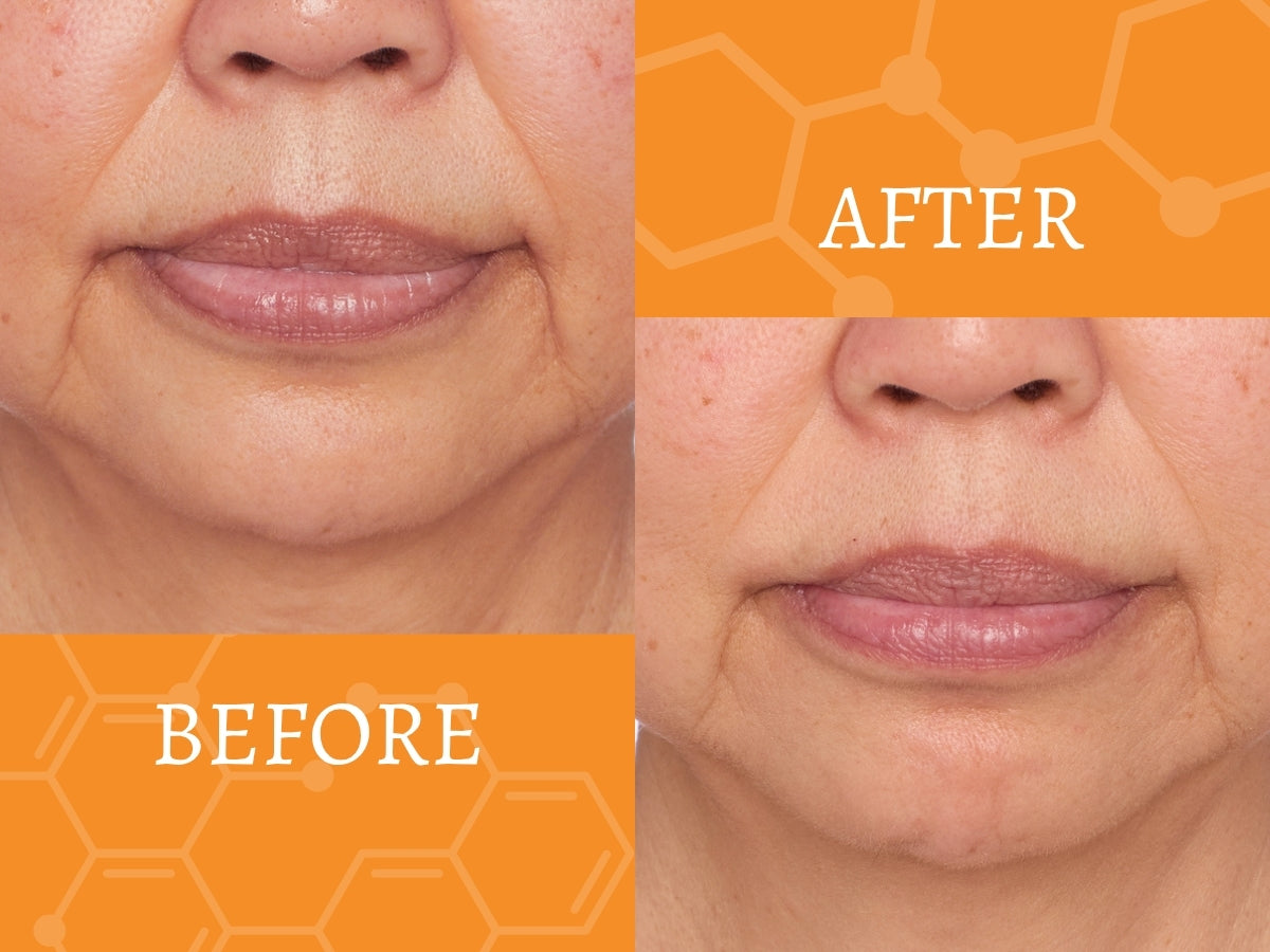 Before and after comparison of a woman's face with visible skin improvement.