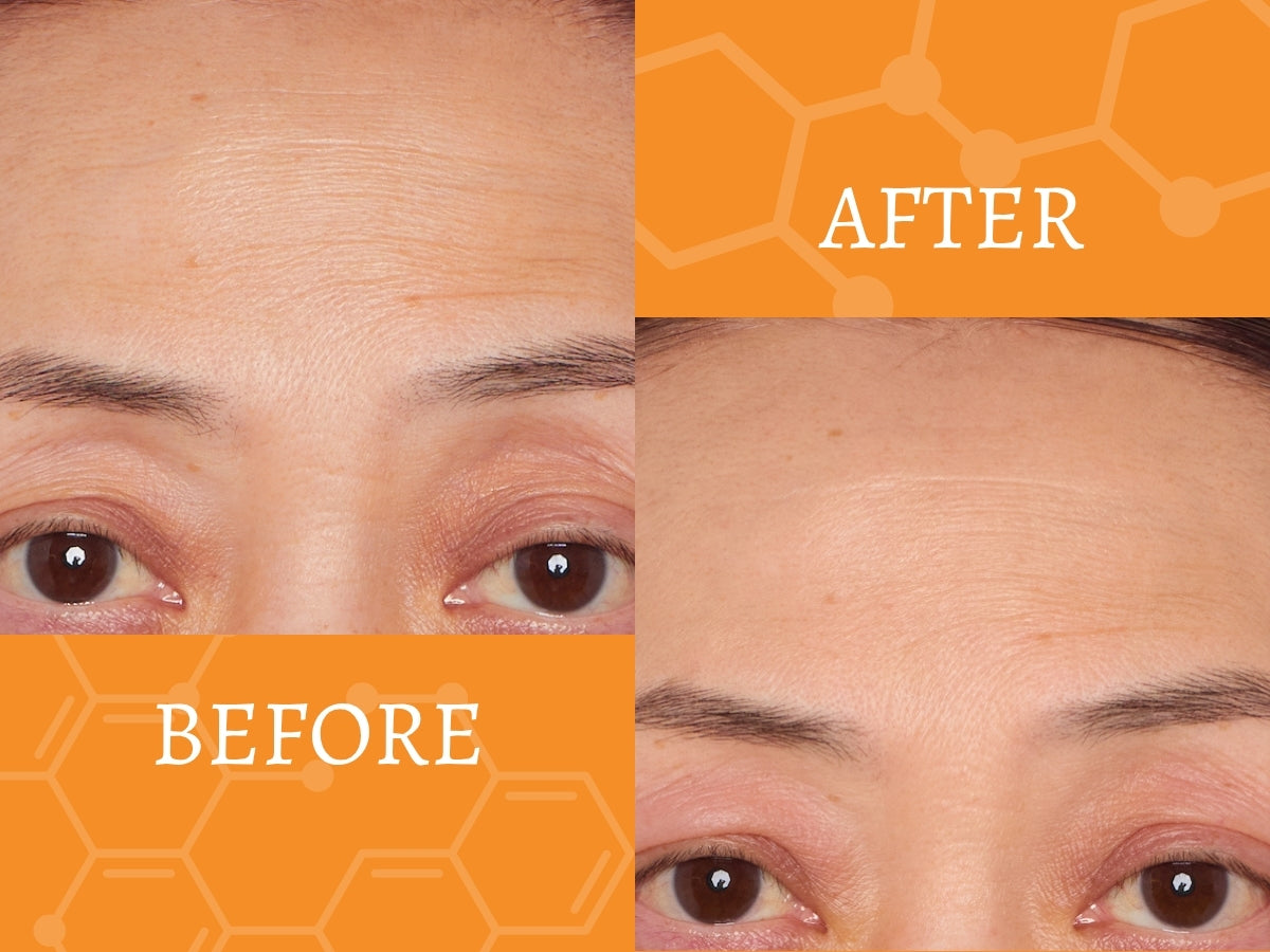 Before and after comparison of forehead skin texture on an orange background